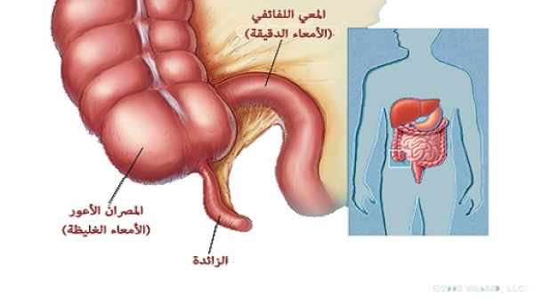 التهاب الزائدة الدودية