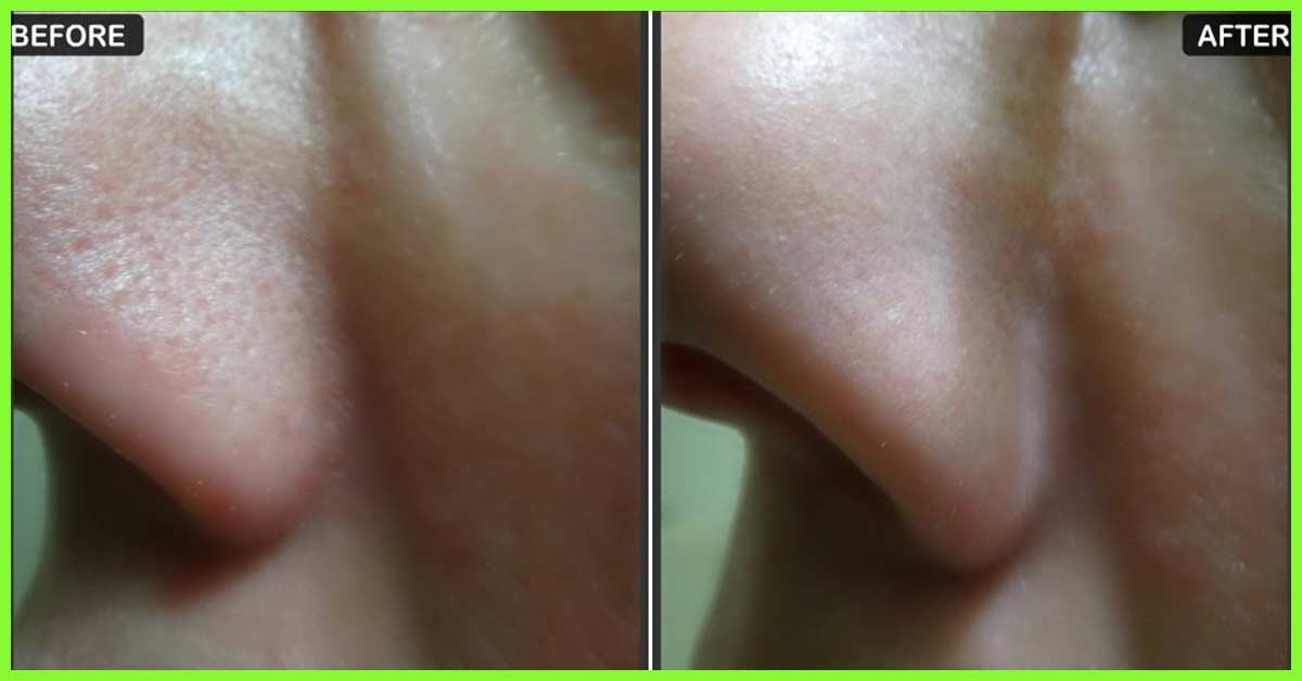 طرق تضييق المسام الواسعة عند الرجال