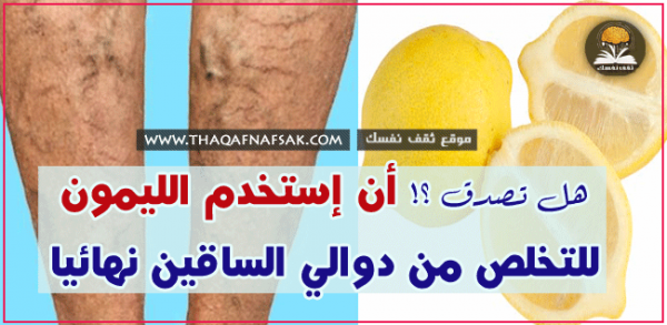 علاج دوالي الساق بالليمون علاج دوالي الساق بالليمون