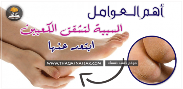أسباب تشقق الكعبين ١٦ سبب تجنبه لتحصل على كعبين ناعمين أسباب تشقق الكعبين ١٦ سبب تجنبه لتحصل على كعبين ناعمين