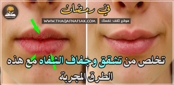 منع جفاف وتشقق الشفاه في رمضان ٩ طرق سريعة