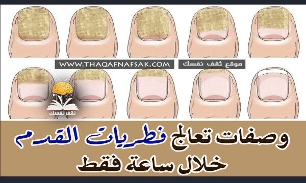 علاج فطريات القدم خلال ساعة فقط