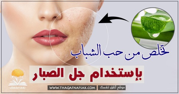 ٧ وصفات من جل الصبار لعلاج حب الشباب سهلة ومفعولها أكيد