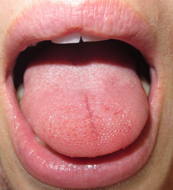 علاج حروق اللسان بـ ٩ طرق طبيعية سريعة علاج حروق اللسان بـ ٩ طرق طبيعية سريعة