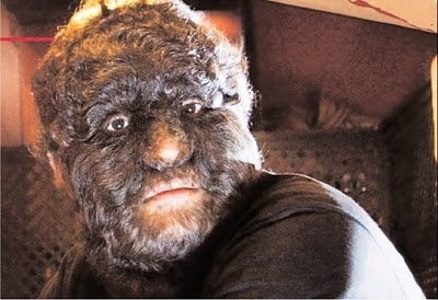 متلازمة الذئب ، بين الحالة المرضية و الأسطورة الخيالية