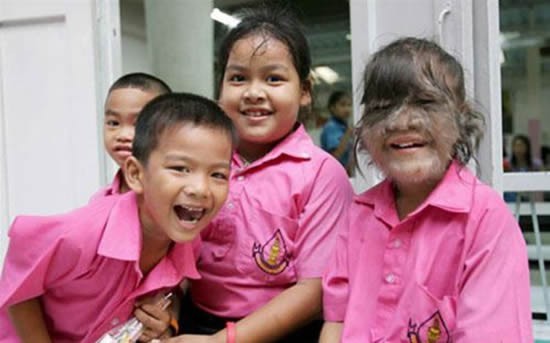 متلازمة الذئب ، بين الحالة المرضية و الأسطورة الخيالية