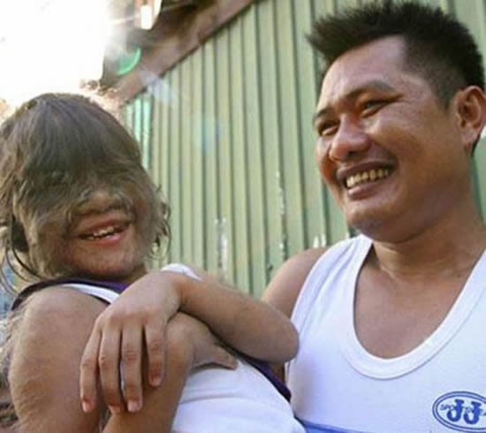 متلازمة الذئب ، بين الحالة المرضية و الأسطورة الخيالية