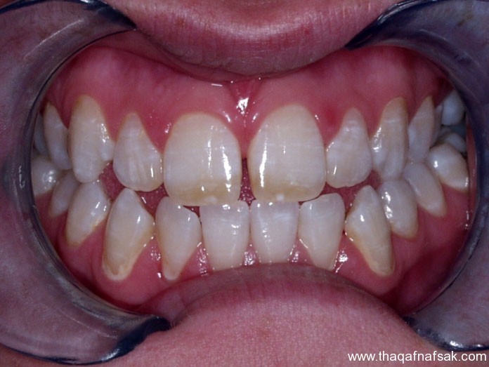 10 حقائق مهمة عن الفلوريد