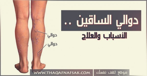 كيف تعالج دوالي الساقين .. الأسباب والعلاج كيف تعالج دوالي الساقين .. الأسباب والعلاج