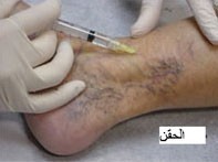كيف تعالج دوالي الساقين .. الأسباب والعلاج كيف تعالج دوالي الساقين .. الأسباب والعلاج