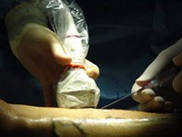 كيف تعالج دوالي الساقين .. الأسباب والعلاج كيف تعالج دوالي الساقين .. الأسباب والعلاج