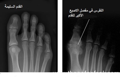 النقرس “أسبابه وعلاجه” النقرس “أسبابه وعلاجه”