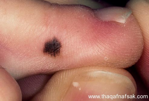 بالصور : اعرف صحتك من قدمك