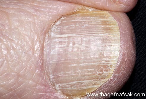 بالصور : اعرف صحتك من قدمك