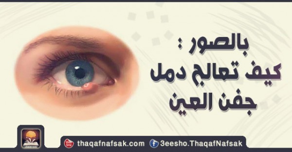 بالصور طريقة علاج دمل العين بطرق منزليه بالصور طريقة علاج دمل العين بطرق منزليه
