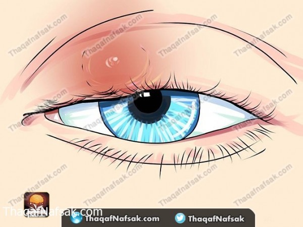 بالصور طريقة علاج دمل العين بطرق منزليه بالصور طريقة علاج دمل العين بطرق منزليه