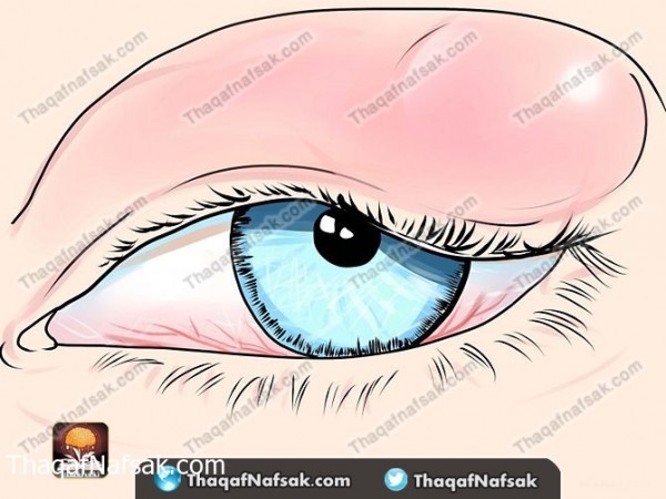 بالصور طريقة علاج دمل العين بطرق منزليه بالصور طريقة علاج دمل العين بطرق منزليه