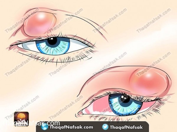 بالصور طريقة علاج دمل العين بطرق منزليه بالصور طريقة علاج دمل العين بطرق منزليه