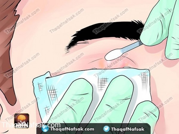 بالصور طريقة علاج دمل العين بطرق منزليه بالصور طريقة علاج دمل العين بطرق منزليه