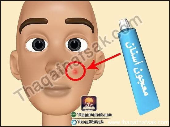 كيف تعالج حب الشباب بنفسك ؟ كيف تعالج حب الشباب بنفسك ؟