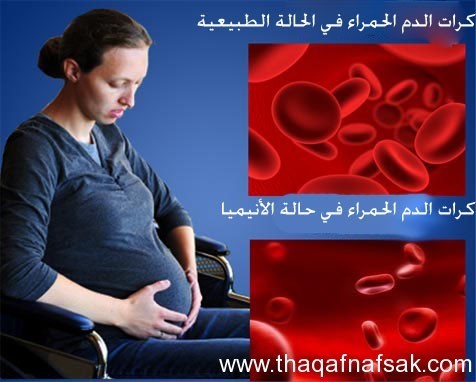تقرير كامل عن مرض الأنيميا تقرير كامل عن مرض الأنيميا