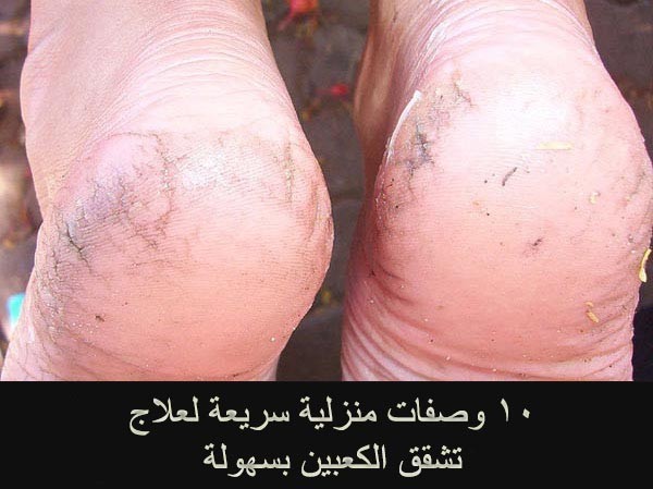وصفات لعلاج تشقق الكعبين١٠ وصفات منزلية اصنعها بنفسك لعلاج تشققات عقب القدم