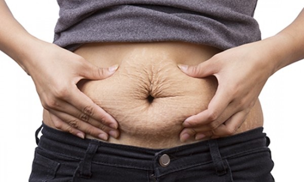 نقدم لك أقوي وأهم خلطات للتخلص من الخطوط البيضاء في الجسم