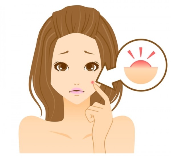 أسهل 5 طرق منزلية تضمن لك علاج حب الشباب في المنزل