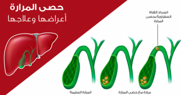 موسوعة شاملة عن حصوات المرارة اسبابها وعلاجها و وصفات منزلية للتخلص منها موسوعة شاملة عن حصوات المرارة اسبابها وعلاجها و وصفات منزلية للتخلص منها