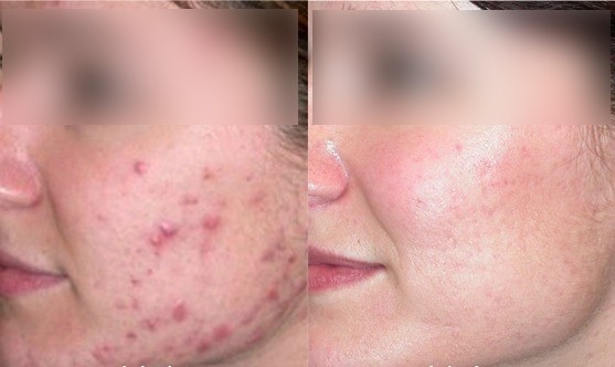 نصائح لعلاج حب الشباب و وصفات طبيعية للتخلص منه ستفيدك جدا نصائح لعلاج حب الشباب و وصفات طبيعية للتخلص منه ستفيدك جدا