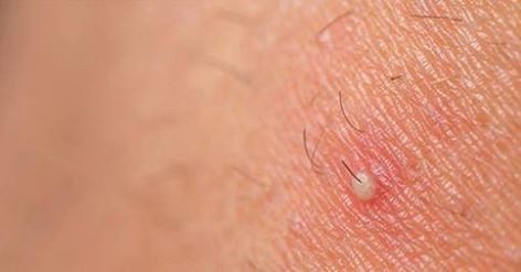 ١٠ وصفات منزلية تمكنك من علاج الدمامل بكل أشكالها