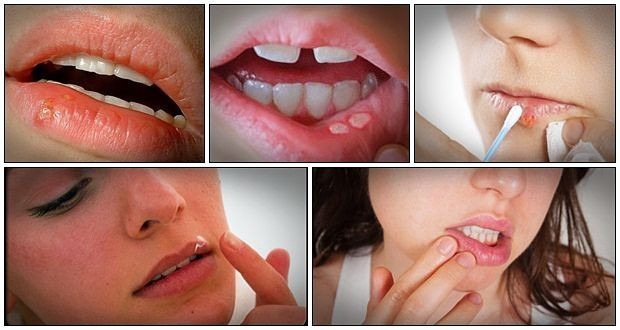 علاج قرح البرد في المنزل و تخلص من شكلها المزعج بسرعة علاج قرح البرد في المنزل و تخلص من شكلها المزعج بسرعة