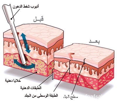 معلومات عن عملية شفط الدهون معلومات عن عملية شفط الدهون