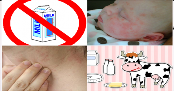 أعراض وأسباب حساسية الحليب وعدم تحمل اللاكتوز وأهم طرق العلاج أعراض وأسباب حساسية الحليب وعدم تحمل اللاكتوز وأهم طرق العلاج
