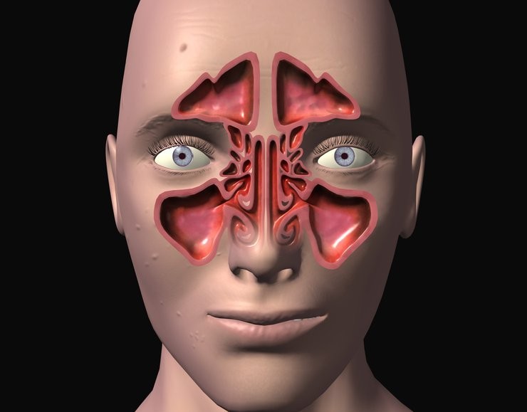٩ حلول سريعة لتخفيف وعلاج التهاب الجيوب الأنفية