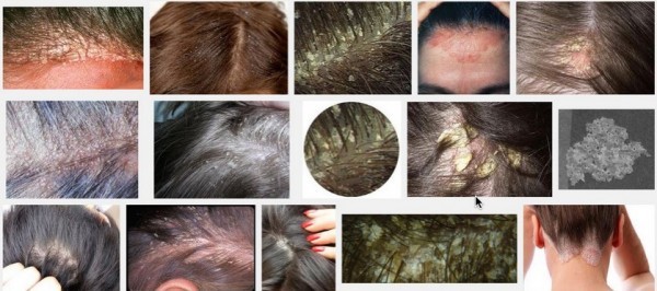 مرجع كامل حول قشرة الشعر اسبابها وعلاجها