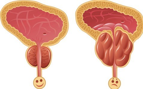 علاج تضخم البروستاتا بدون جراحة في المنزل علاج تضخم البروستاتا بدون جراحة في المنزل