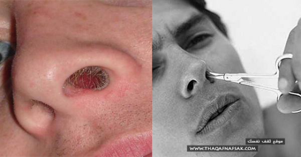 دليلك المصور لتعرف كيفية إزالة شعر الأنف الزائد دليلك المصور لتعرف كيفية إزالة شعر الأنف الزائد