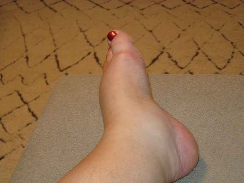 أسباب شائعة وراء تورم القدمين والعلاجات الفعالة