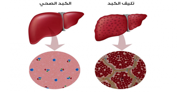 تشمع وتليف الكبد أسباب الإصابه به وطرق الوقاية منه
