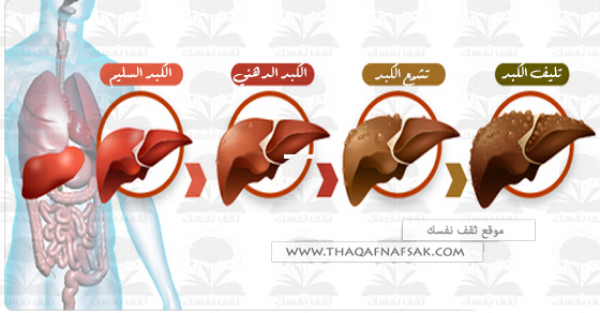 تشمع وتليف الكبد أسباب الإصابه به وطرق الوقاية منه تشمع وتليف الكبد أسباب الإصابه به وطرق الوقاية منه