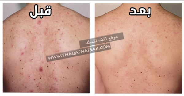 علاج حبوب الظهر مع ١٢ طريقة بنتيجة أكيده