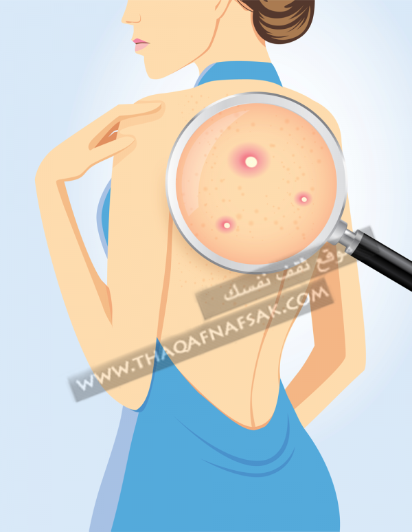 علاج حبوب الظهر مع ١٢ طريقة بنتيجة أكيده علاج حبوب الظهر مع ١٢ طريقة بنتيجة أكيده