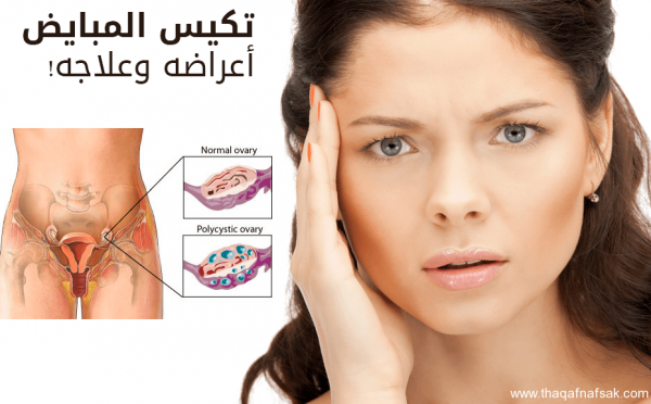 تكيس المبايض أسبابه وعلاجه
