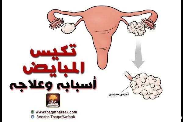 تكيس المبايض أسبابه وعلاجه تكيس المبايض أسبابه وعلاجه