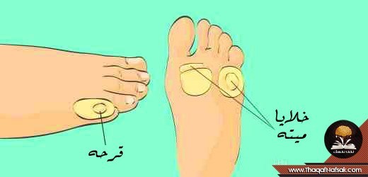 بالصور علاج قرحة القدم طبيعيا بالصور علاج قرحة القدم طبيعيا