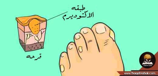 بالصور علاج قرحة القدم طبيعيا بالصور علاج قرحة القدم طبيعيا