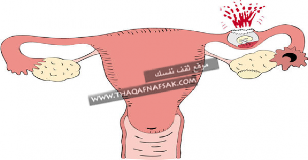 كيف يحدث الحمل خارج الرحم والأعراض والمخاطر كيف يحدث الحمل خارج الرحم والأعراض والمخاطر