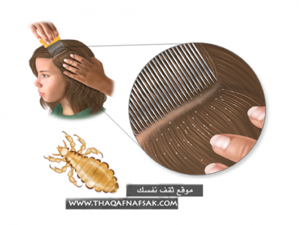 علاج القمل المنتشر في الشعر بوصفات منزلية سهلة علاج القمل المنتشر في الشعر بوصفات منزلية سهلة
