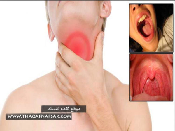 علاجات منزلية لمواجهه وعلاج إلتهاب الحنجرة علاجات منزلية لمواجهه وعلاج إلتهاب الحنجرة